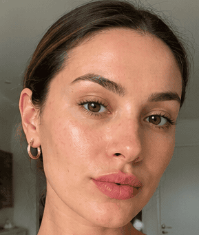 Close-up of a woman with clear, glowing skin after aesthetic treatment.