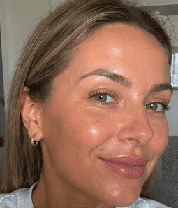 Close-up of a woman with clear, glowing skin after aesthetic treatment.