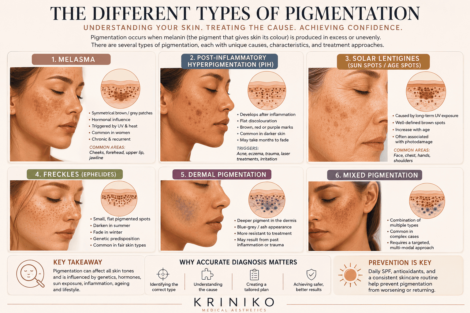 Infographic showing the six different types of skin pigmentation and their characteristics.